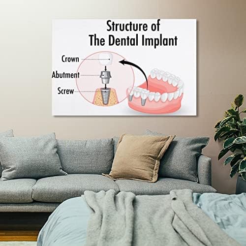 BLUDUG Infographic Human in Structure of the Dental Implant Posters Dental Poster Canvas Pintura Poster de Arte da Parede Para