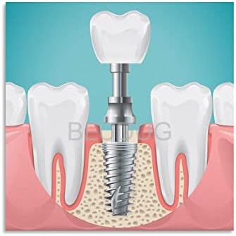 BLUDUG Dental Hospital Poster Dental Implant Poster Dental Canvas Posters Posters e Impressões de Arte de Parede Para